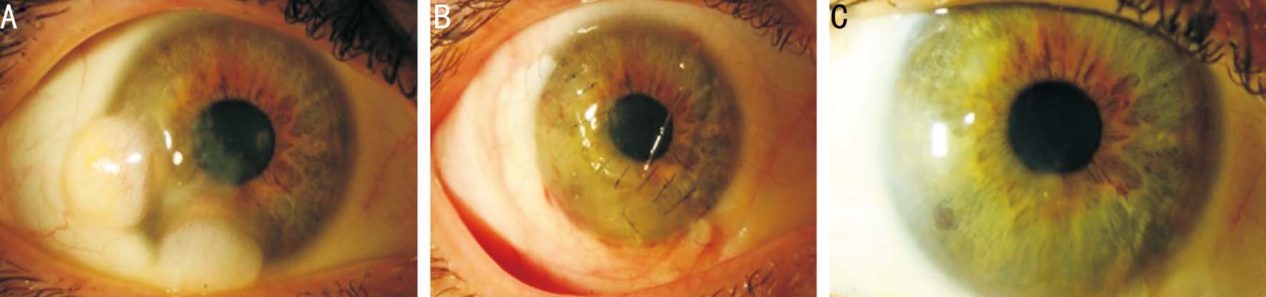 Lamellar Keratoplasty With Corneoscleral Graft For Limbal Dermoids